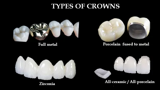 Dental Crown Services: Types and Costs