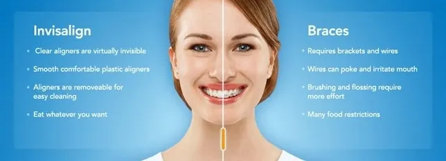Invisalign vs Braces