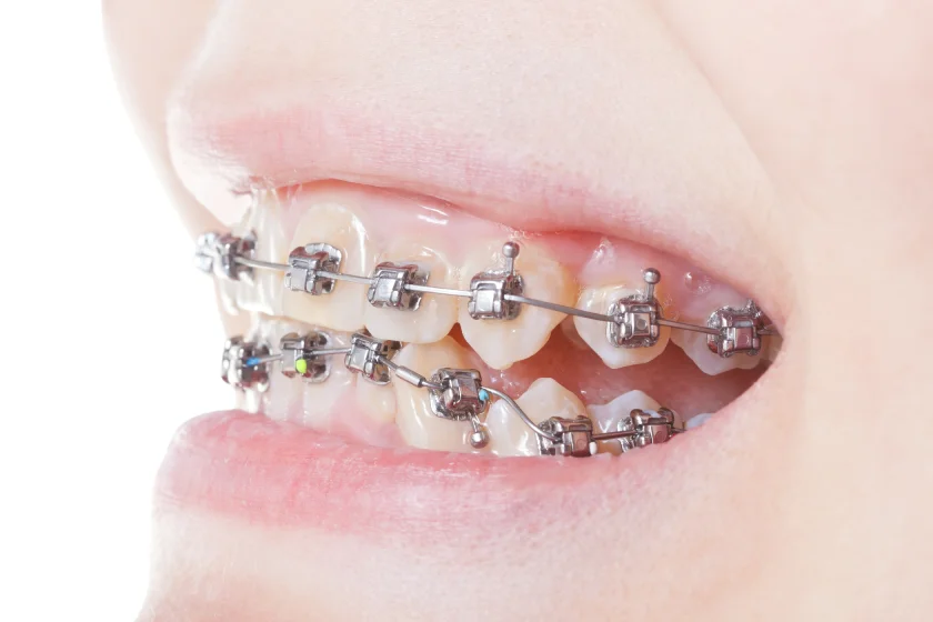 Side view of self-ligating student braces on a student’s teeth highlighting bracket and wire details.