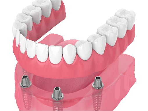 Implant Surgery Over Denture Package Mysmile Dental Clinic