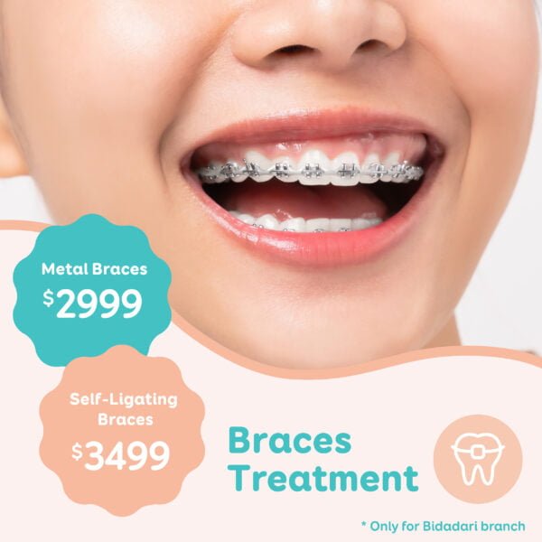 Braces packages (Bidadari Branch) MySmile Dental Clinic