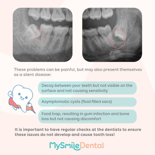 should i remove wisdom teeth mysmile dental