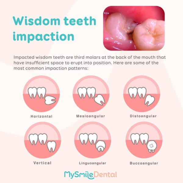 Impacted Wisdom Teeth! - MySmile Dental Clinic