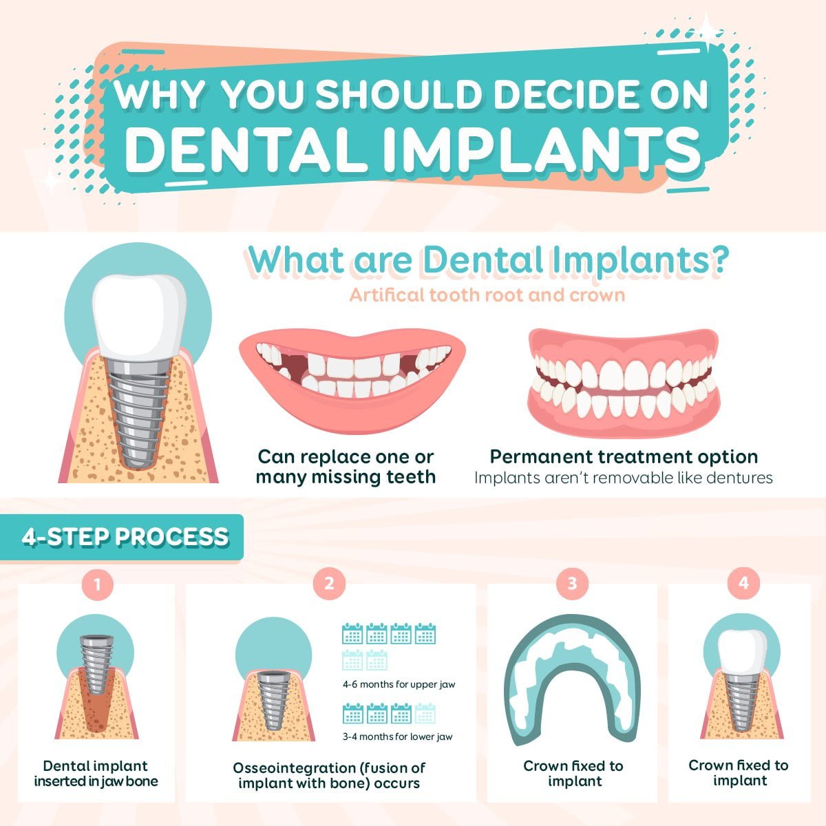 Why dental implants? - MySmile Dental Clinic