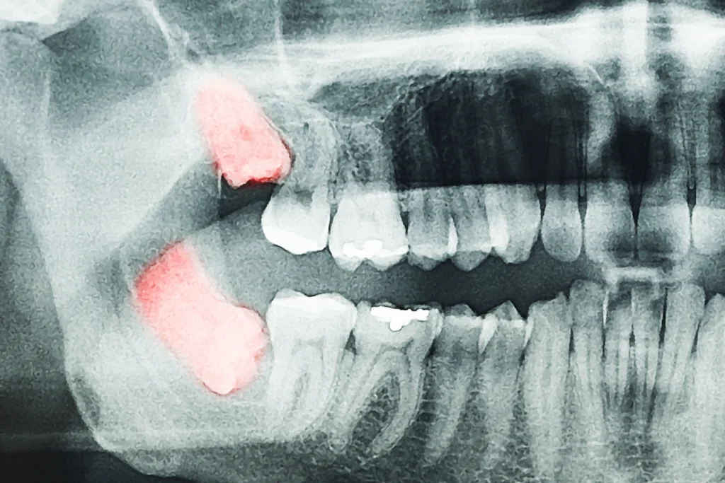 wisdom tooth dental clinic in singapore | MySmile Dental