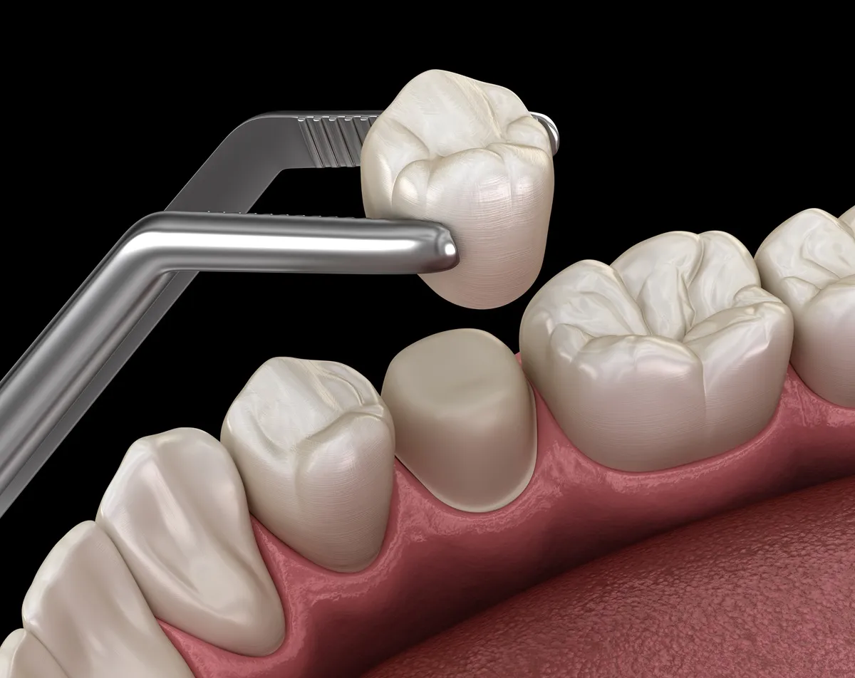 Dental Crown Services