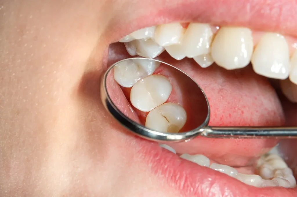 Close-up view of a tooth undergoing a composite tooth filling procedure showing the dental caries removal and restoration process