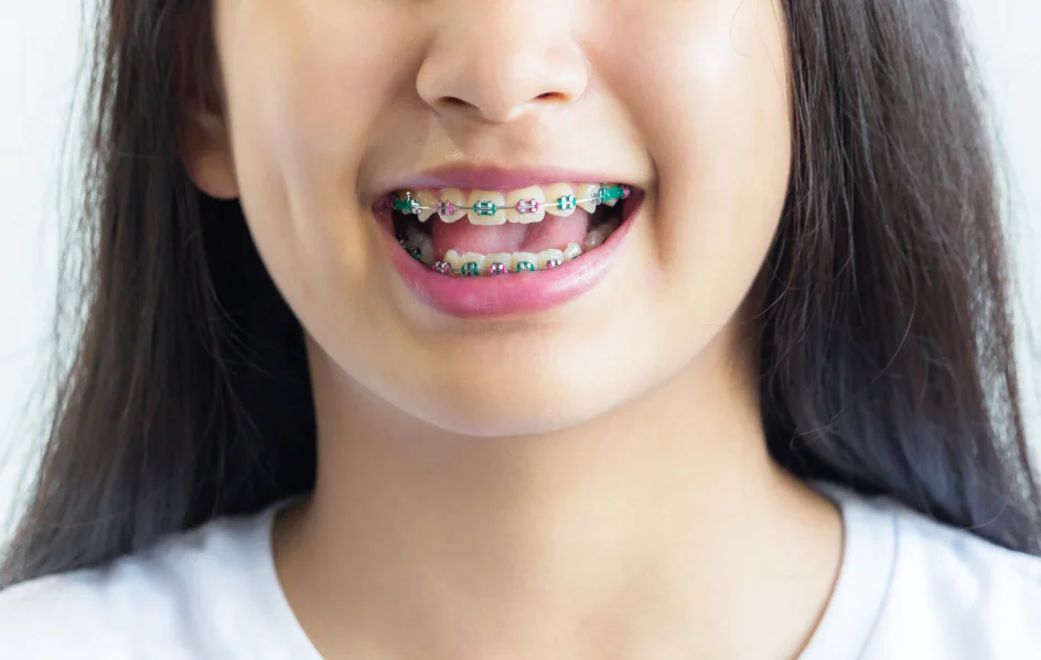 Close-up of a smiling Asian female student showing her traditional metal student braces.